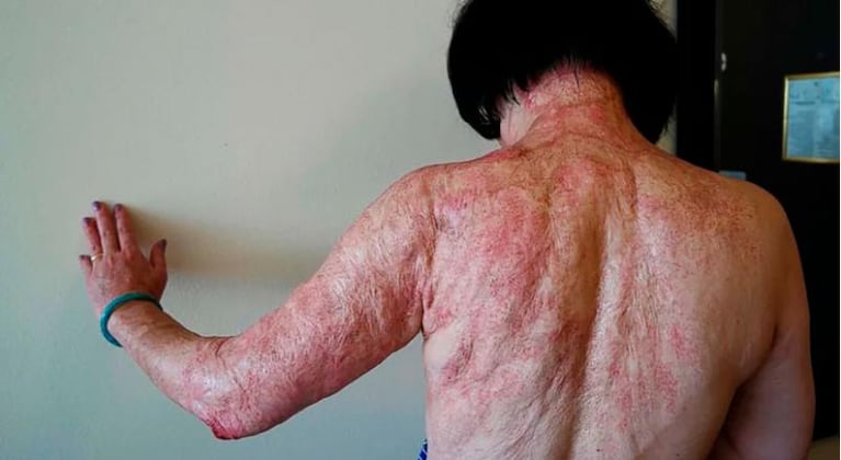 A 50 años de su icónica foto, la “niña del napalm” pudo curar su piel
