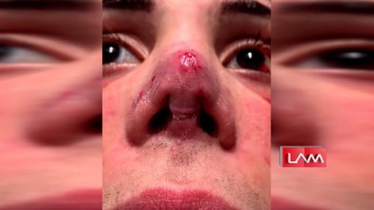 A Felipe Pettinato se le infectó la nariz y lo internaron de urgencia