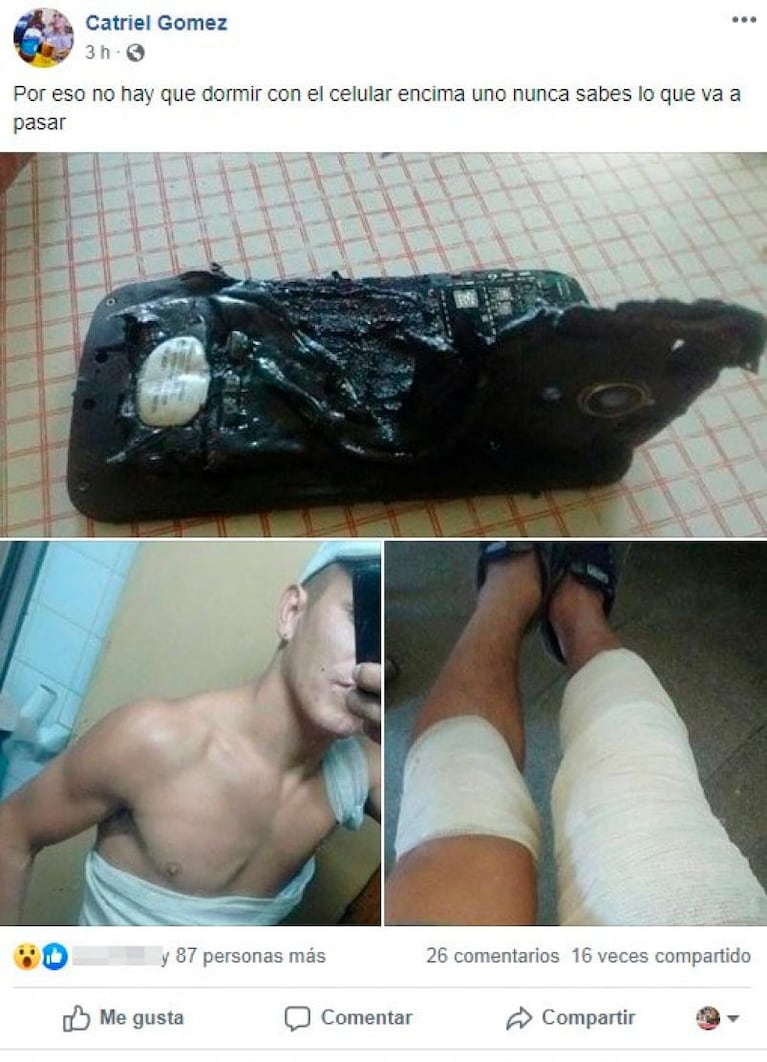 A un cordobés le explotó el celular mientras dormía y sufrió graves quemaduras