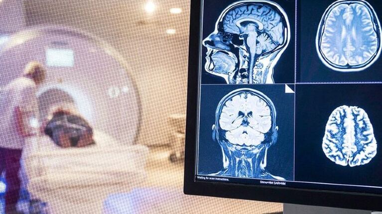 Advierten que el coronavirus podría causar daños en el cerebro.