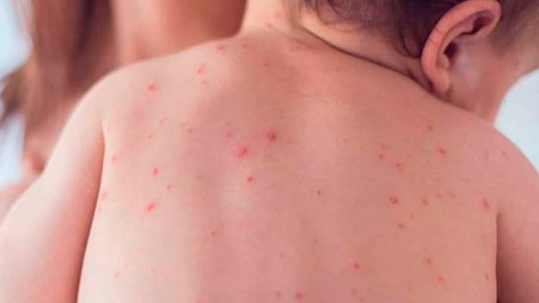 Alerta por sarampión en Córdoba. 
