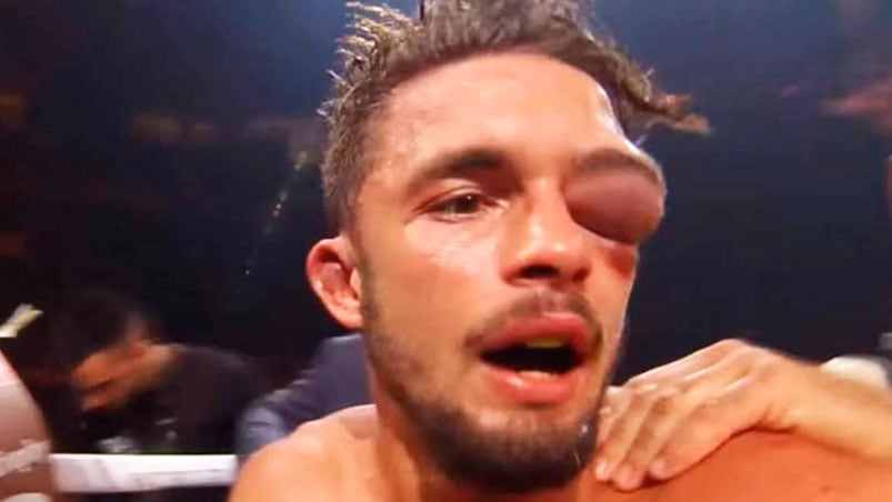 Anthony Yigit no podía ver con su ojo izquierdo. 