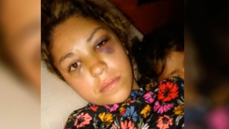Antonella Torres sufrió graves heridas en su rostro y otras partes del cuerpo.