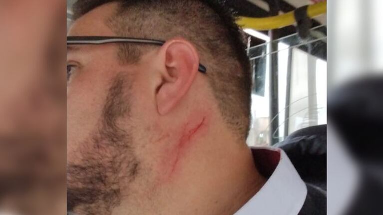 Así quedó el cuello del conductor de 32 años.