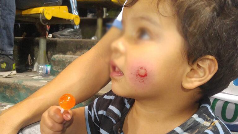 Así quedó el rostro del pequeño. Foto: Juan Manrique / El Doce y Vos.