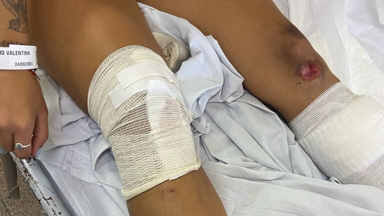Así quedó una joven tras ser arrastrada por motochoros.