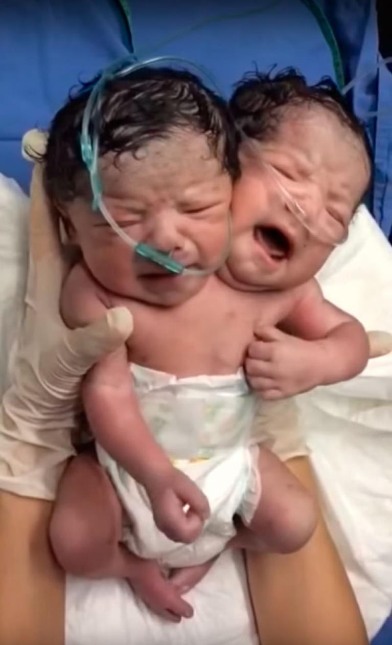 Asombro por el nacimiento de un bebé de dos cabezas en México