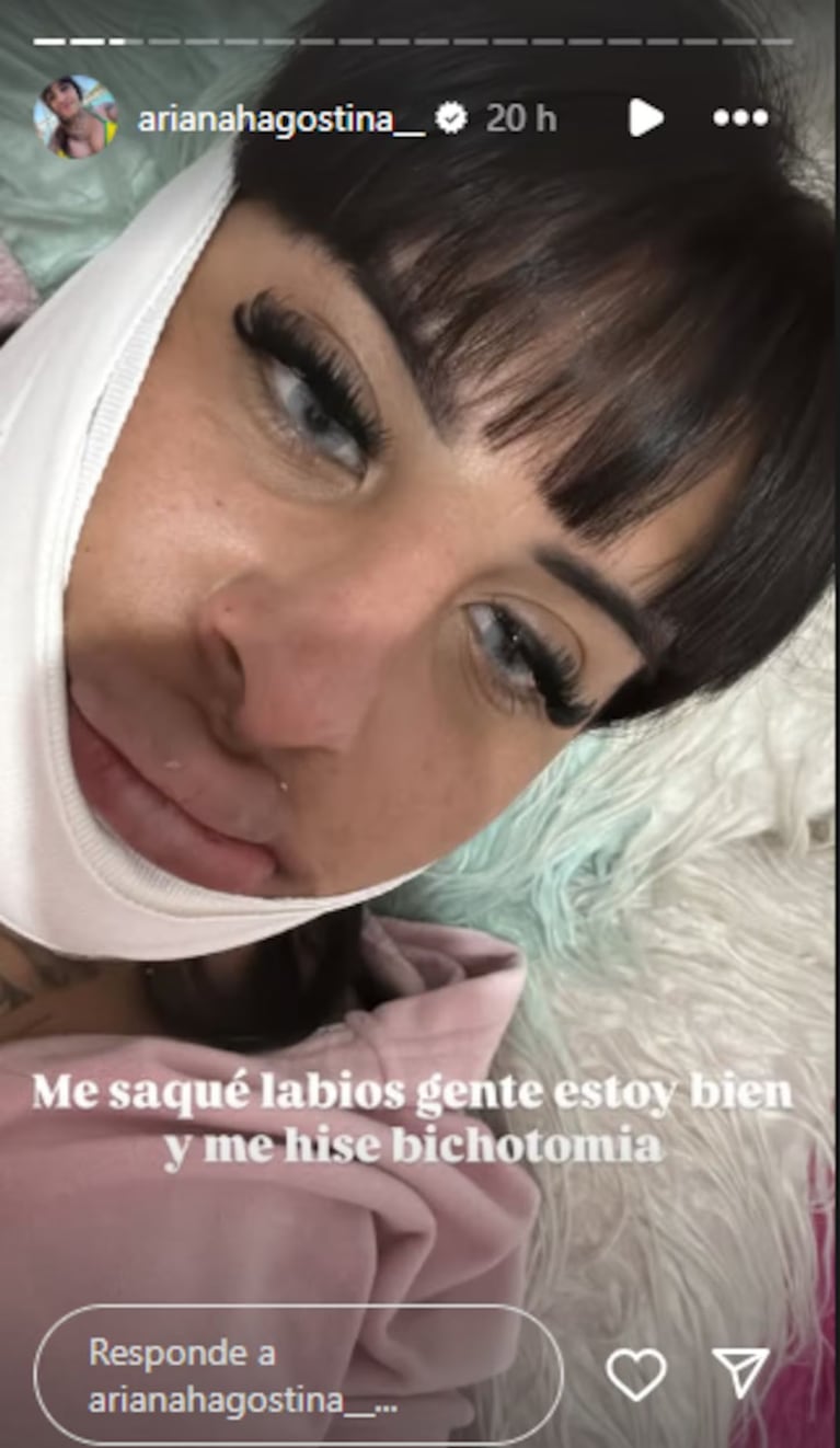 “Bichectomía”: La Coqueta se retocó los labios y mostró el impactante resultado
