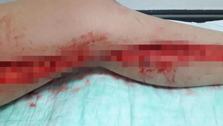 Brutal ataque a una adolescente: le cortaron desde la ingle hasta el tobillo con un vidrio