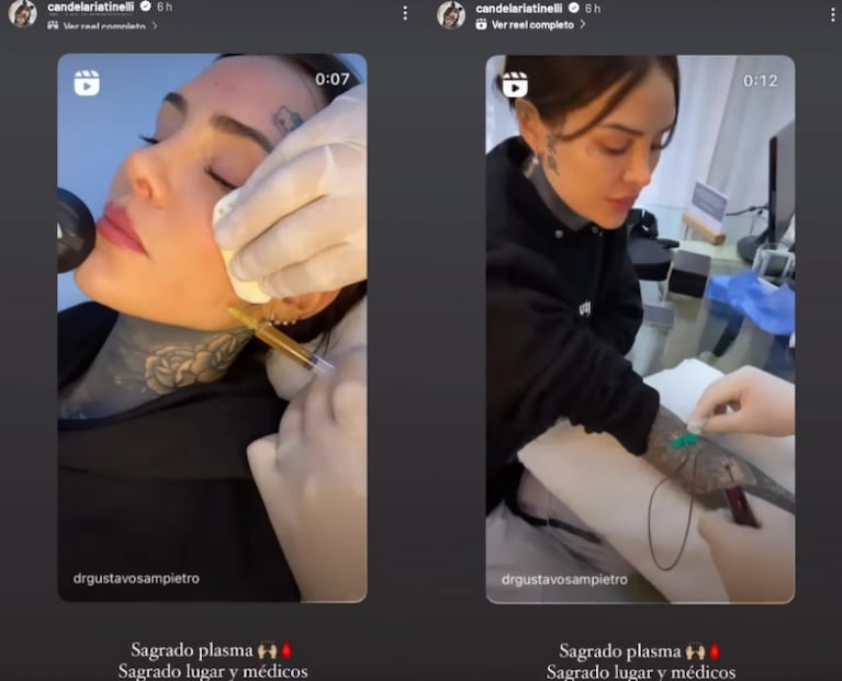 Cande Tinelli se hizo un nuevo tratamiento estético después de borrarse el tatuaje