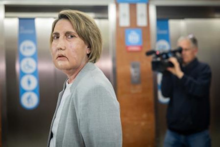 Carme, la mujer española que recibió un trasplante de cara.
