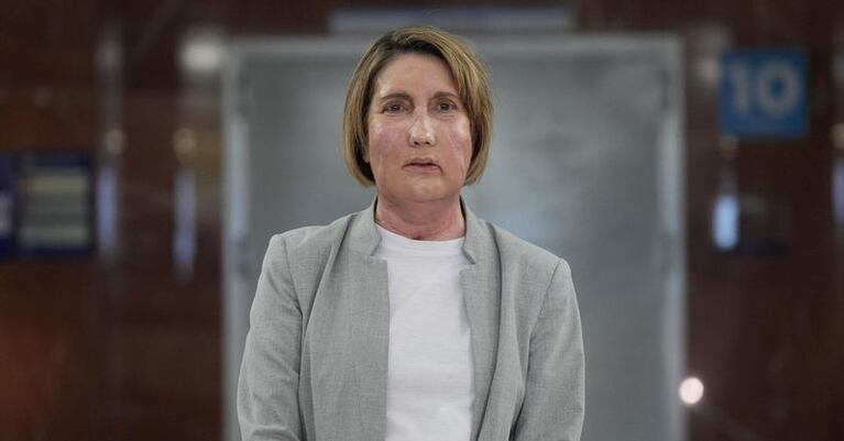 Carme, la mujer española que recibió un trasplante de cara.