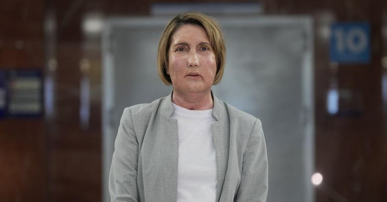 Carme, la mujer española que recibió un trasplante de cara de una donante en eutanasia.