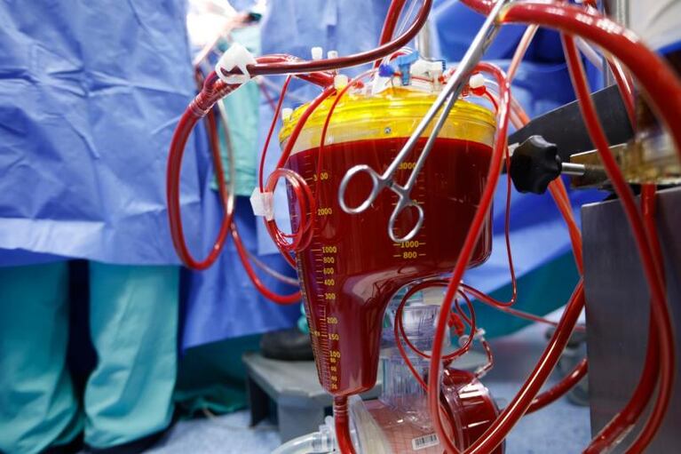 Cirugía de película: enfriaron su cuerpo, le sacaron su sangre y liberaron sus pulmones