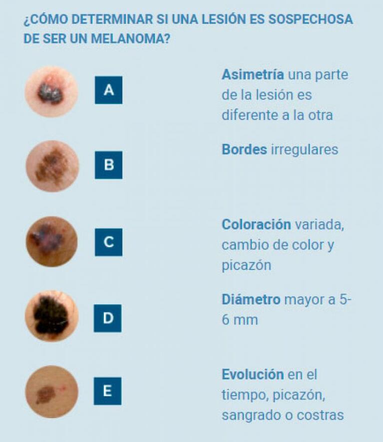 Córdoba contra el cáncer de piel: realizarán chequeos gratuitos de lunares