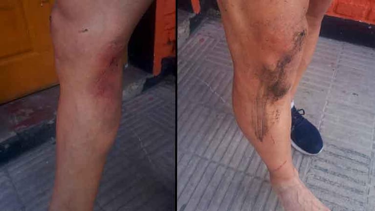 Córdoba: pisó una tapa de la cloaca mal cerrada y terminó herido en el hospital