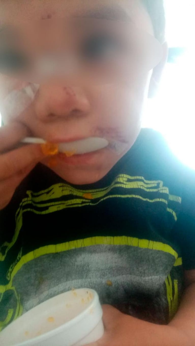 Córdoba: un nene fue atacado por un pitbull y recibió 40 puntos en la cara