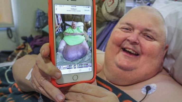 Creían que era grasa y resultó ser un tumor gigante