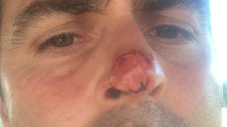 De un mordisco, le arrancaron un pedazo de nariz a un futbolista argentino
