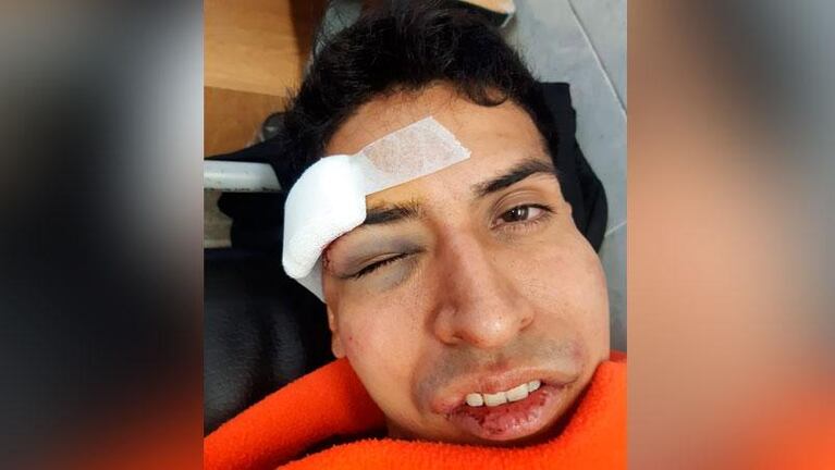 Denunció que salió a bailar en Carlos Paz y le dieron una brutal golpiza