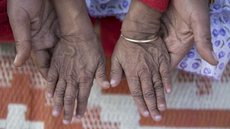 Dos nenes sufren "la enfermedad de Benjamin Button"