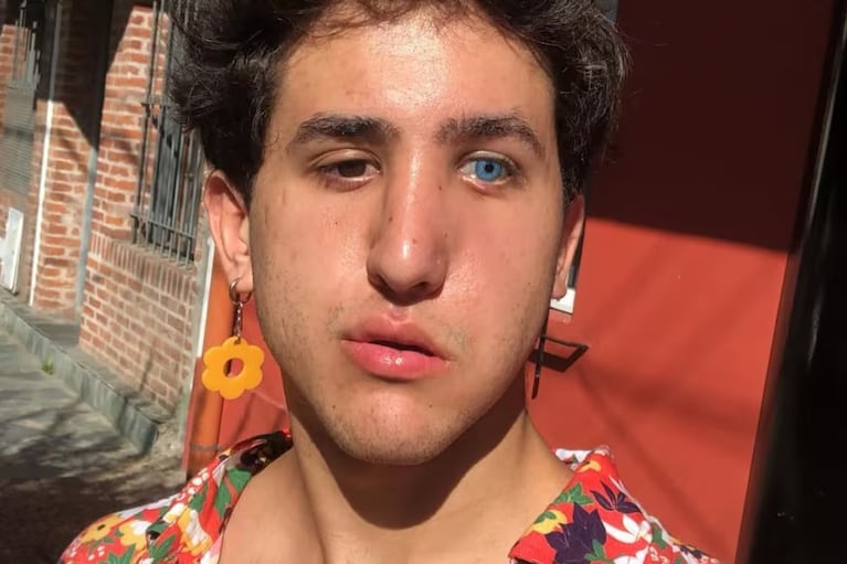 El actor de El Eternauta relató el terrible accidente que le provocó la parálisis facial