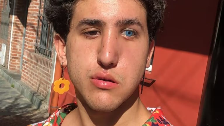 El actor de El Eternauta relató el terrible accidente que le provocó la parálisis facial