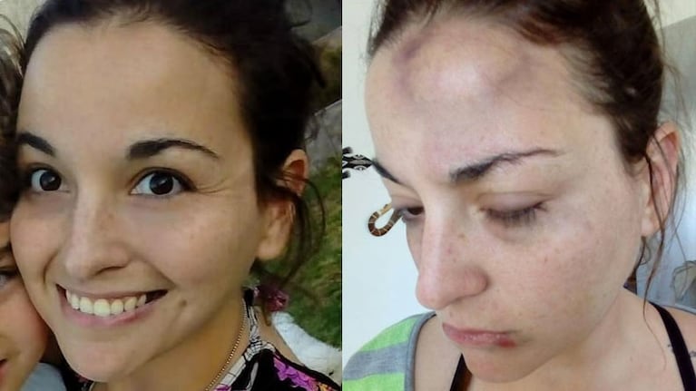 El antes y el después: "Vicky" comparó cómo quedó su rostro con una que foto que tomó ese mismo día.