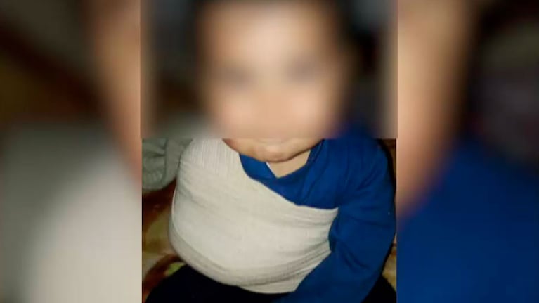 El bebé fue vendado y su brazo estará inmovilizado durante 40 días.