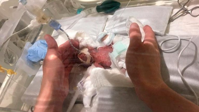 El bebé más pequeño del mundo sobrevivió al parto y ya recibió el alta médica