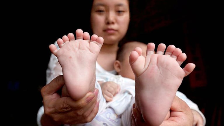 El bebé nació con polidactilia y lo heredó de su mamá. 
