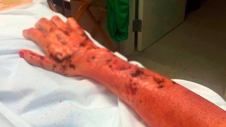 El brazo de Juana Viale, listo para grabar su nueva película.