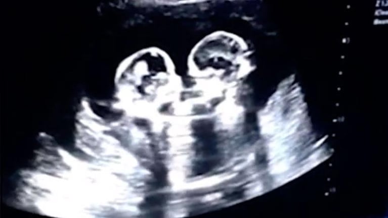 El conmovedor video de dos gemelas peleándose en el vientre de su madre