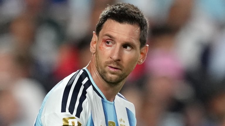 El golpe que sufrió Lionel Messi en el ojo derecho durante el partido con Suiza. (Foto: AP)