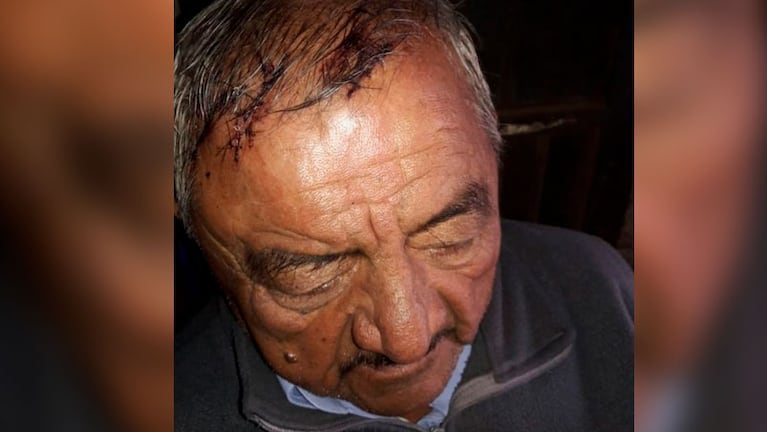 El hombre recibió 18 puntos de sutura en su cabeza tras el ataque de los ladrones.