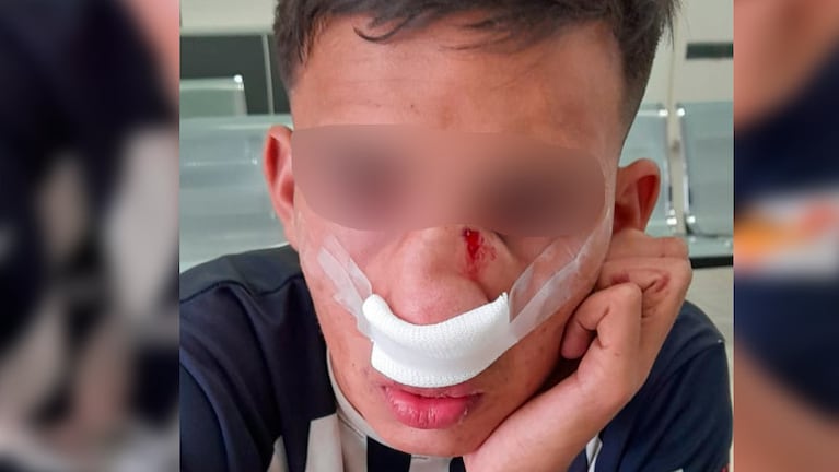 El joven agredido sufrió una fractura en la nariz.