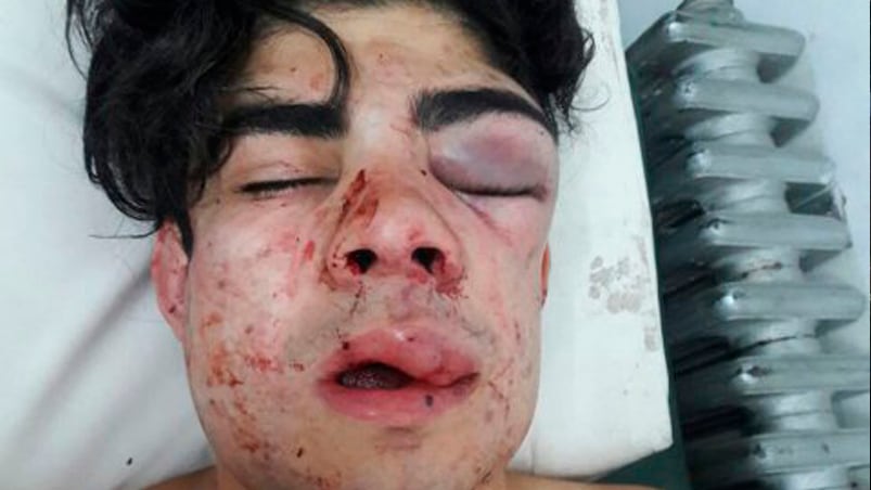 El joven agredido tiene múltiples quebraduras de mandíbula, nariz y maxilar. Foto: diario Los Andes