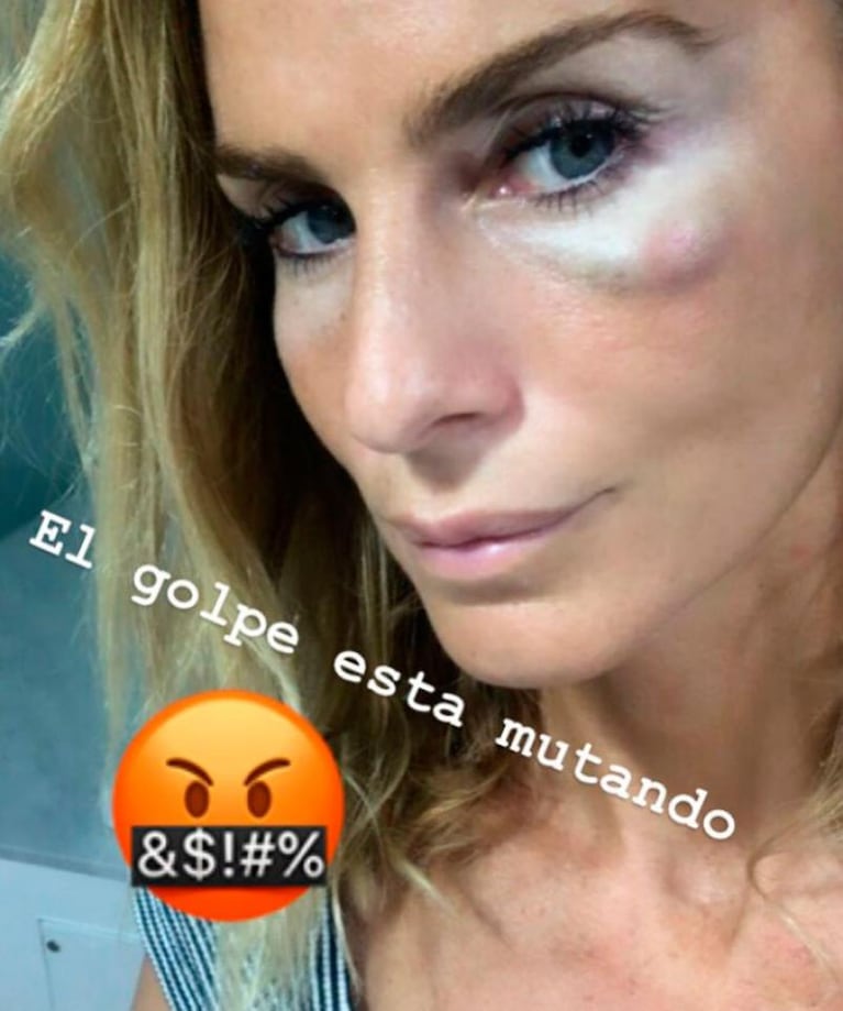 El moretón de Sabrina Rojas tras recibir un golpe de Paula Chaves