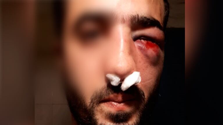El muchacho golpeado quedó con coágulos y sangrado en la nariz.