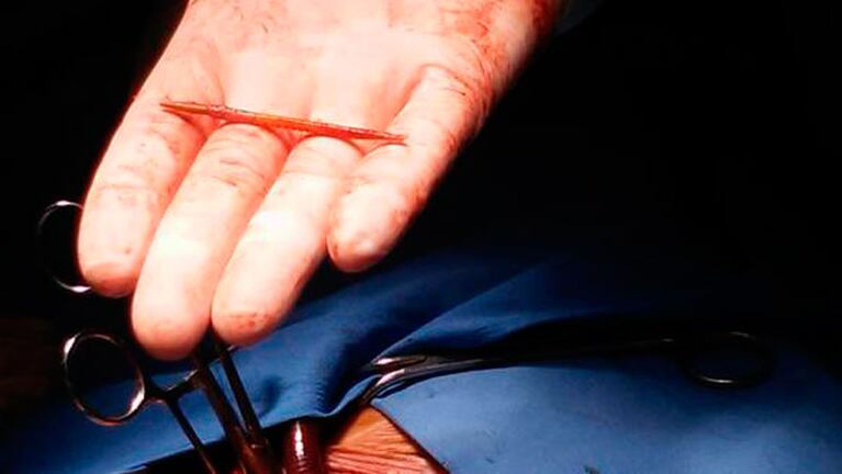 El objeto apareció en la vena cava inferior.