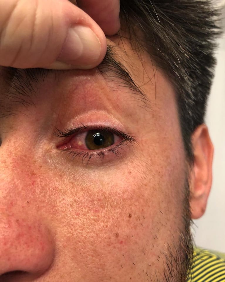 El ojo de Pérez, claramente afectado tras el ataque de hinchas de River.