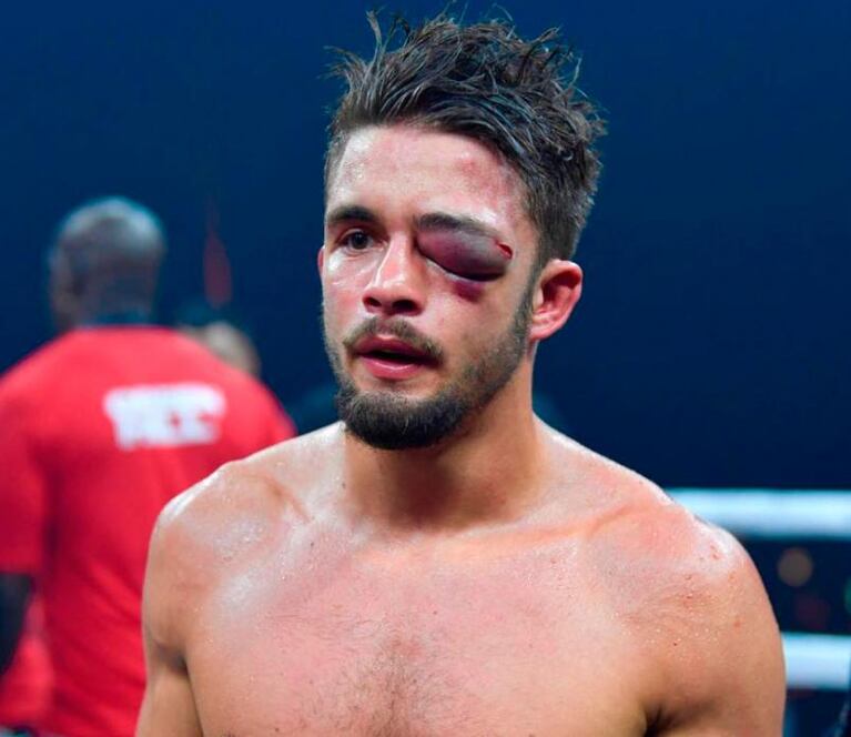 El ojo inflamadísimo y viral del boxeador Anthony Yigit