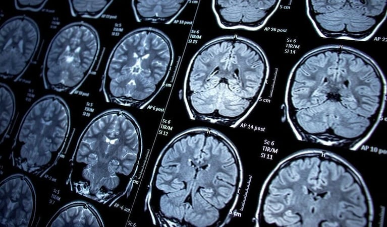 El Parkinson es una enfermedad neurodegenerativa.
