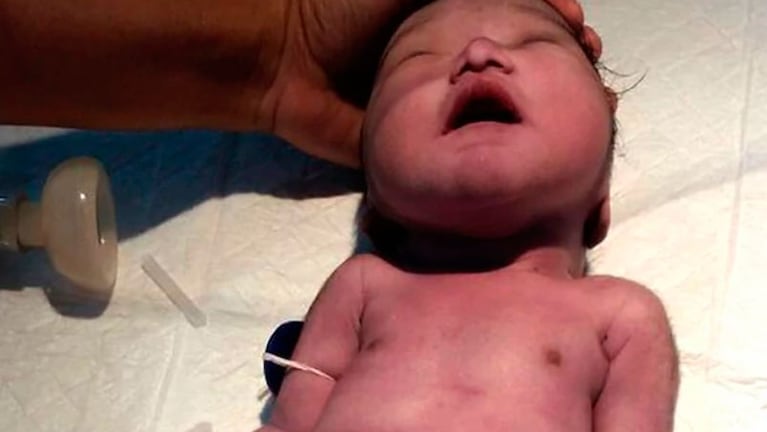 El primer "bebé sirena" nacido en India sólo sobrevivió durante diez minutos en 2016.