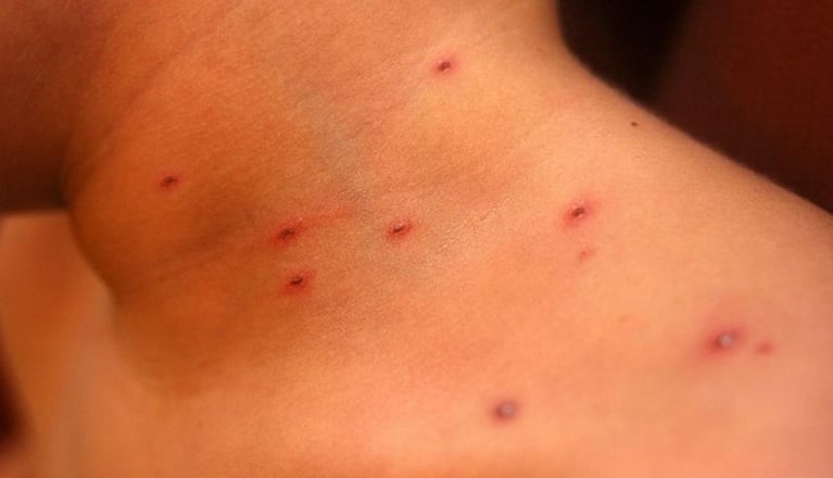 El sarampión se puede contagiar antes y después de la aparición de erupciones en la piel.