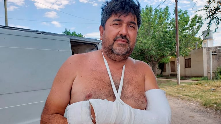 El vecino perdió dos dedos y sufrió una fractura. Foto: Néstor Ghino/ElDoce.tv.
