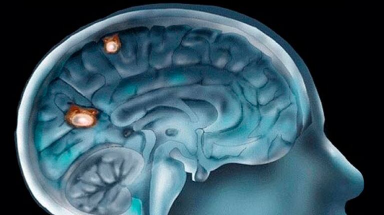 Estiman que el índice de mortalidad de esta enfermedad es del 97 por ciento. Imagen ilustrativa.
