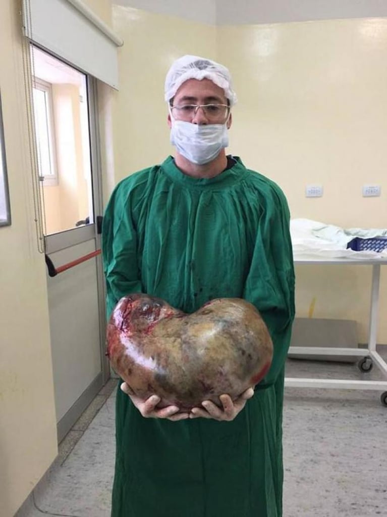 Extrajeron un tumor de 15 kilos a una mujer