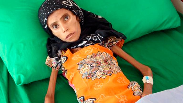 Fatima Qoba es uno de los 5 millones de niños víctimas de la guerra en Yemen.