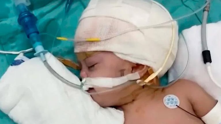Gemelas unidas por la cabeza pudieron verse por primera vez tras una cirugía que duró 12 horas